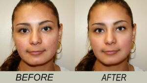 Read more about the article 3 Home Remedy Tip That Are Guaranteed To Work To Eliminate Dark Spot And Clear Scars